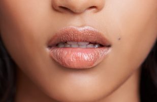 Lip Fillers